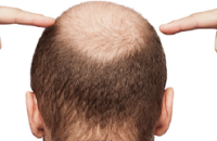 выпадение волос у мужчины